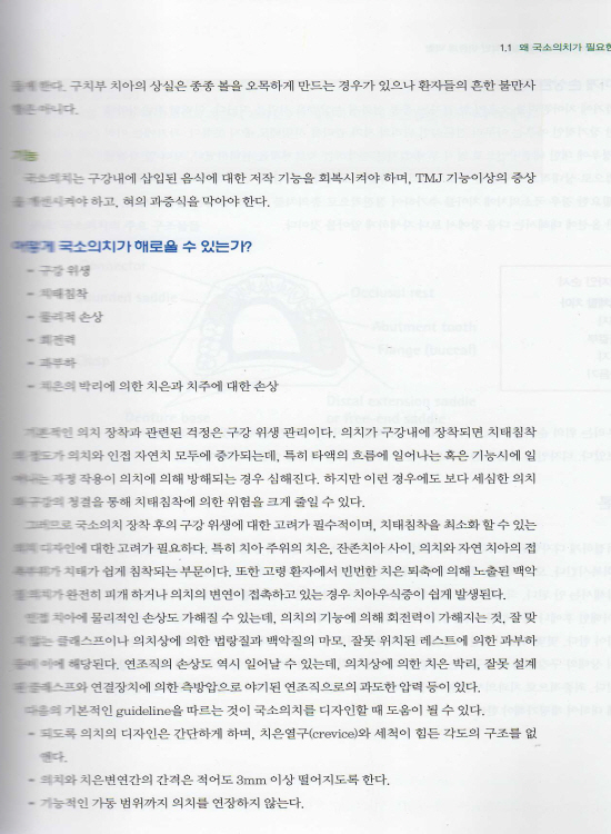 이해하기 쉬운 국소의치 디자인