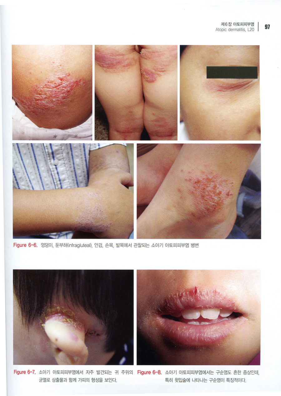 한국에 흔한 피부질환 (Common Skin Diseases in Korea)