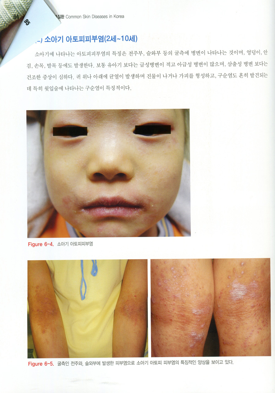 한국에 흔한 피부질환 (Common Skin Diseases in Korea)