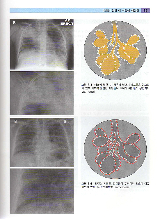 흉부 X선 실전가이드 - The Chest X-Ray : A survival guide