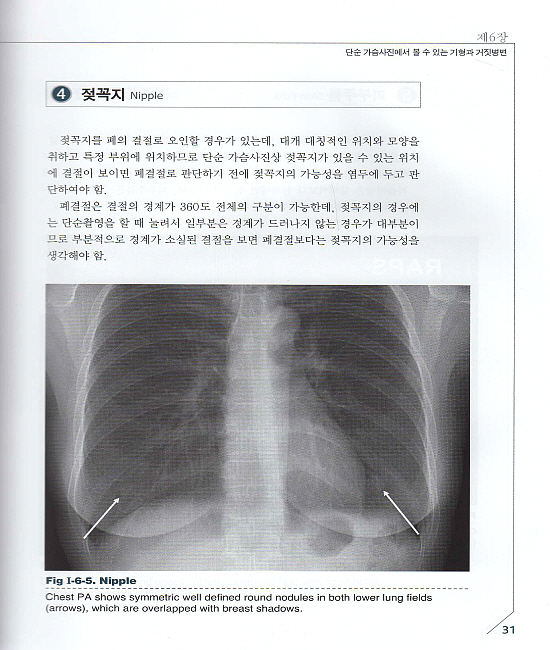 응급흉부영상의학