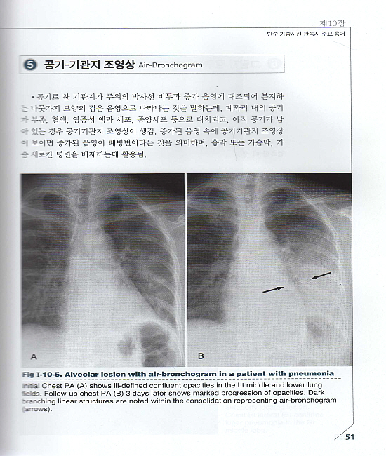 응급흉부영상의학