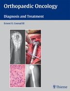 Orthopaedic Oncology (Diagnosis and Treatment)