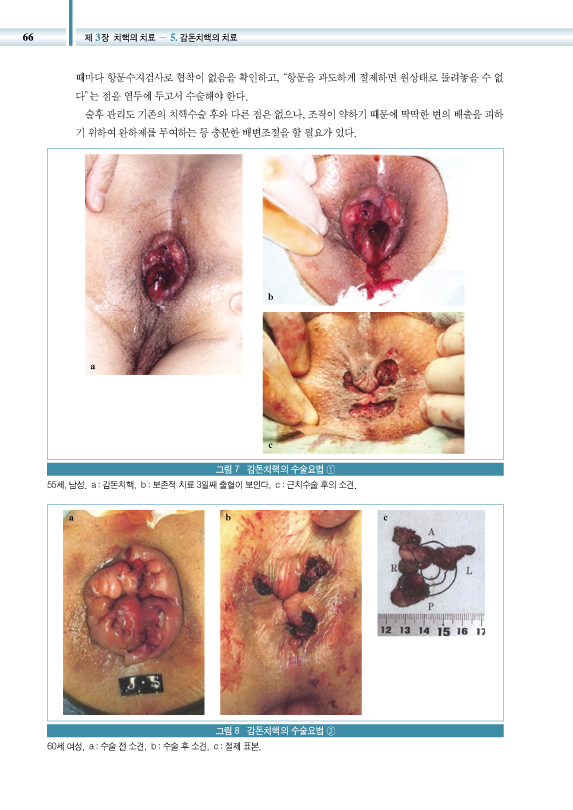 최신 항문(치질) 질환 수술 테크닉