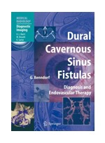 Dural Cavernous Sinus Fistulas: Diagnosis & Endovascular Therapy