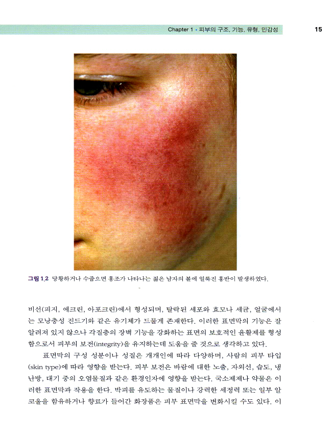 주사(딸기코)의 진단과 치료 - Rosacea