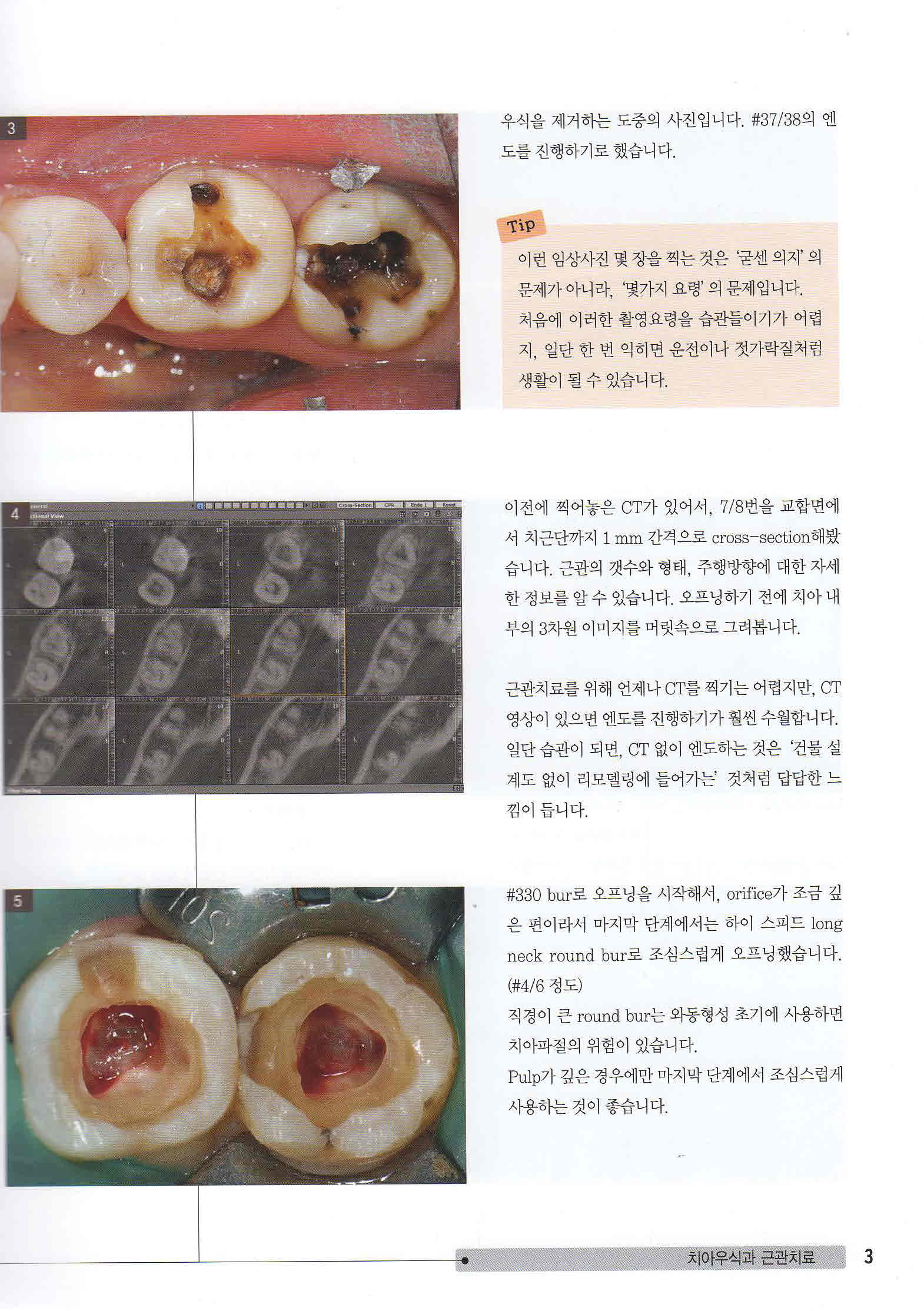 눈으로 배우는 근관치료 1