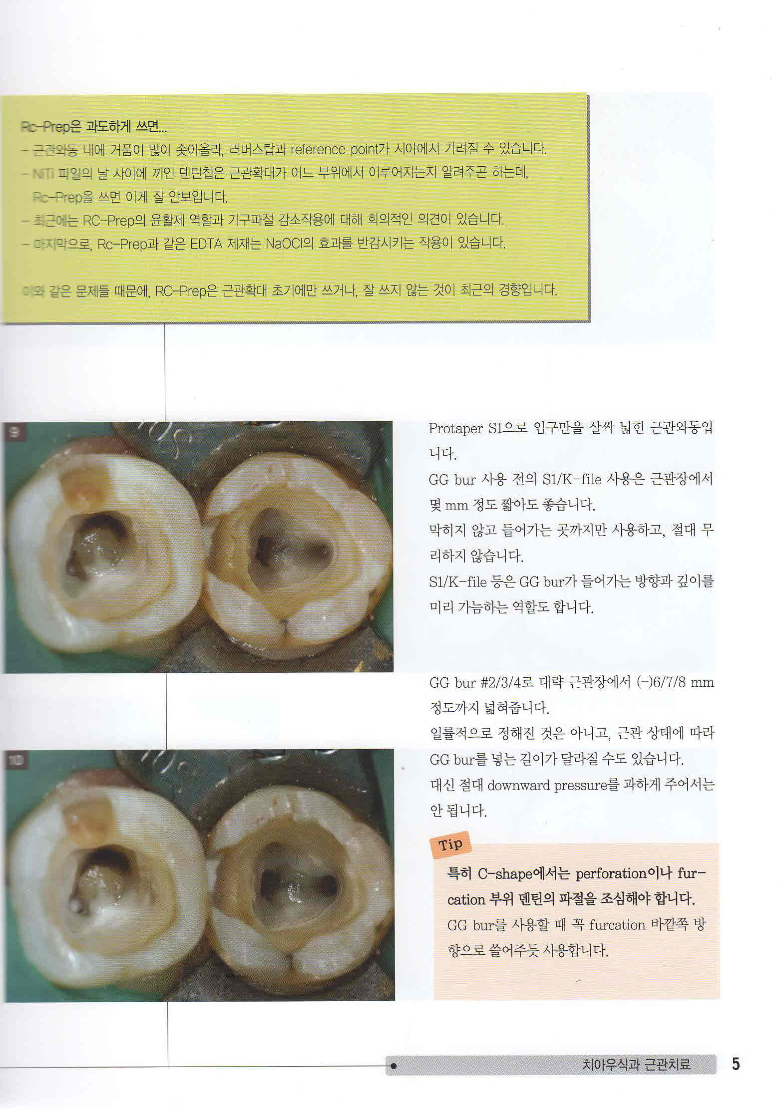 눈으로 배우는 근관치료 1