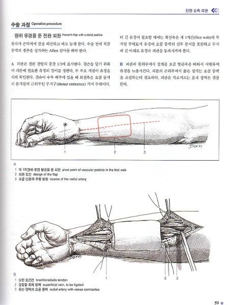 근골격계 피판 수술의 아틀라스 An Atlas of Flaps of the Musculoskeletal System