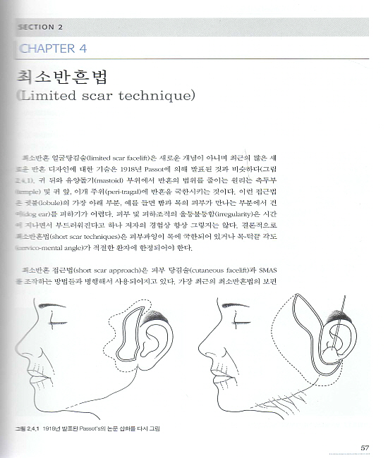 얼굴주름성형술