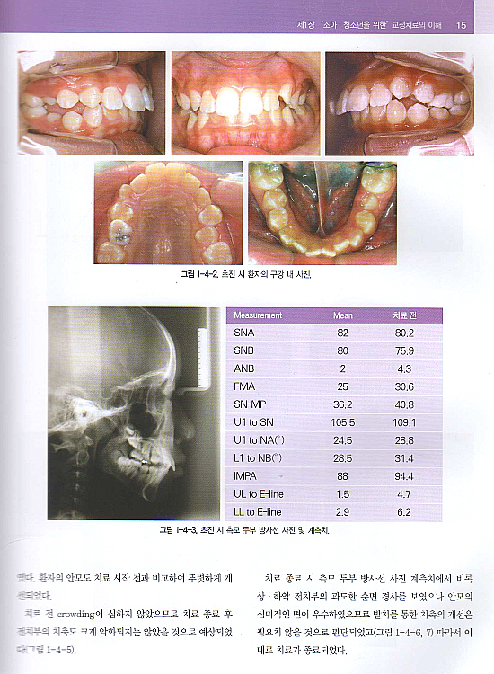 소아청소년을 위한 교정치료의 ABC