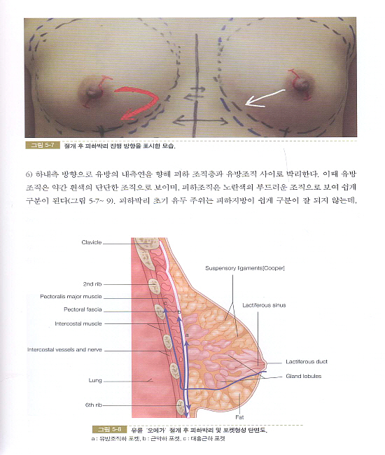 유방성형술 (군자출판사)