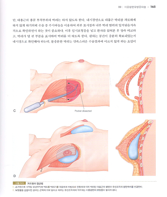 유방성형술 (군자출판사)