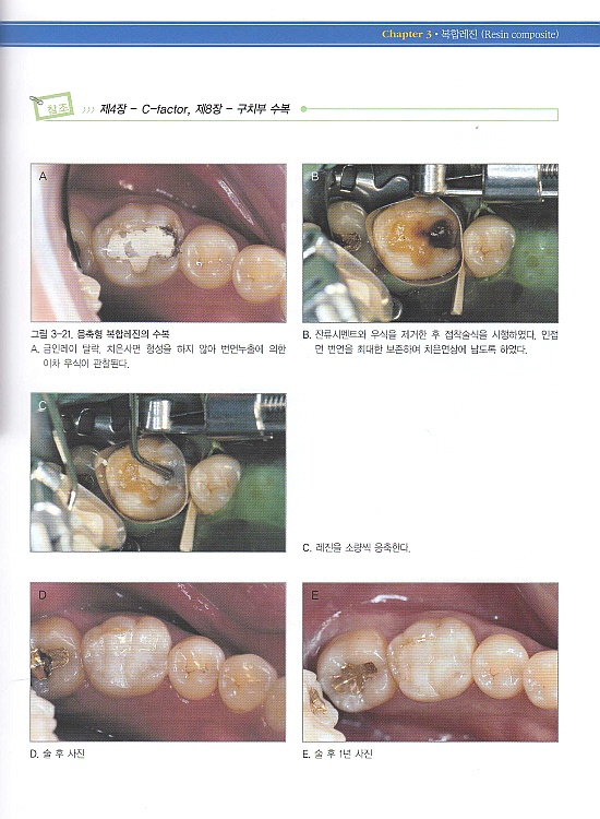 꼭 알아야할 접착과 심미수복의 임상