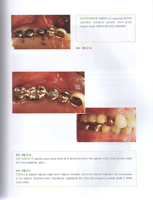 임프란트를 성공으로 이끄는 수술매뉴얼 Key of Implant (CD포함)