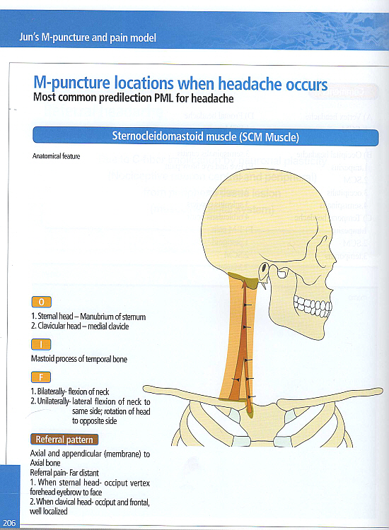 Jun\'s M-Puncture & pain model(영문판)