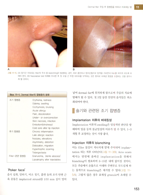 필러를 이용한 안면회춘술 Facial Rejuvenation with Fillers, Includes DVD