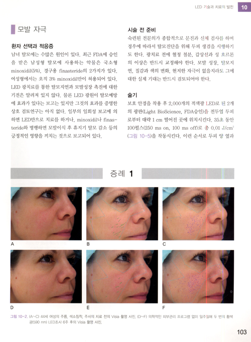 레이저와 비침습기기를 이용한 피부재생 Lasers and Non-Surgical Rejuvenation with DVD