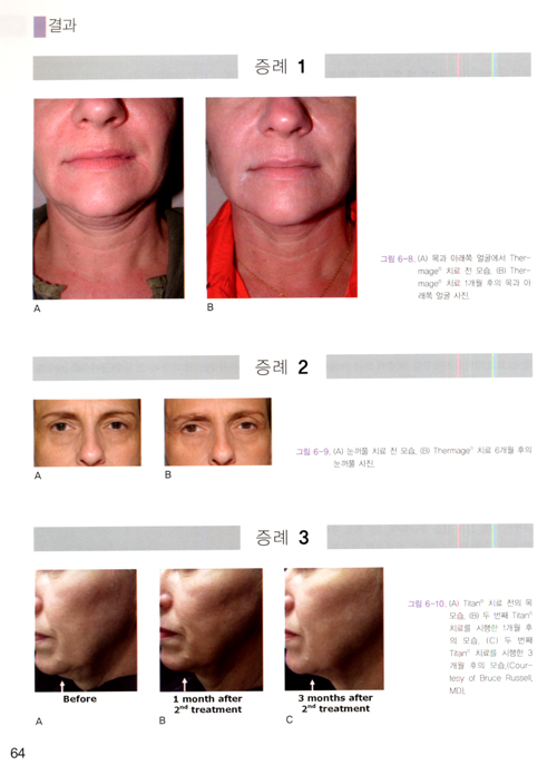 레이저와 비침습기기를 이용한 피부재생 Lasers and Non-Surgical Rejuvenation with DVD