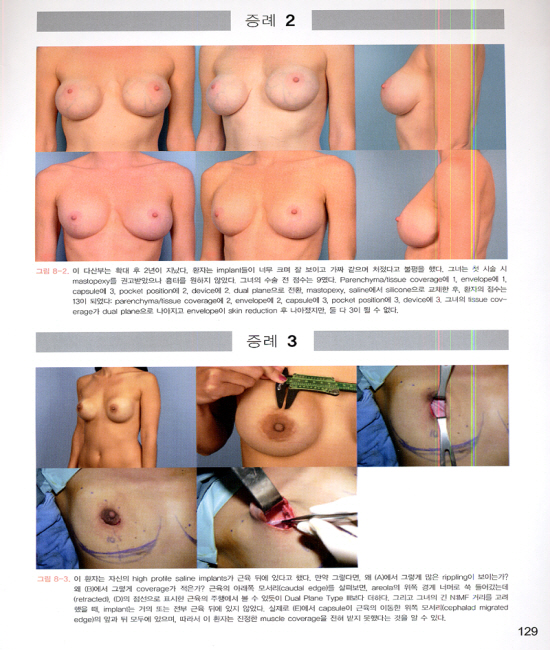 미용유방성형 Aesthetic Breast Surgery, includes DVD