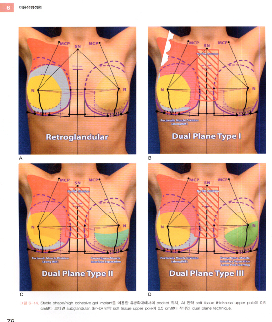 미용유방성형 Aesthetic Breast Surgery, includes DVD