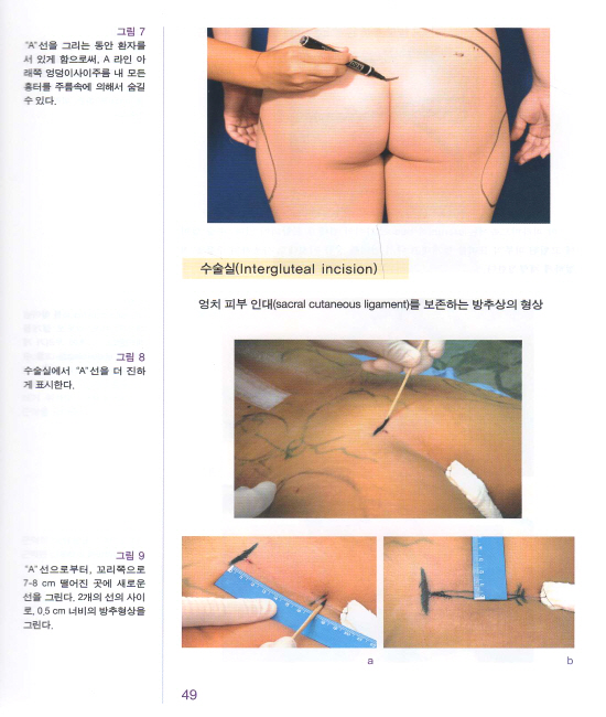 둔부성형술(허벅지와 종아리 윤곽술을 포함한)  DVD포함