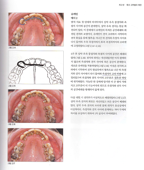 인코그니토를 이용한 설측교정치료