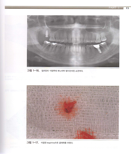 성공적인 임프란트를 위한 골재생 테크닉- 제2편