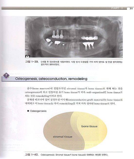 성공적인 임프란트를 위한 골재생 테크닉- 제2편