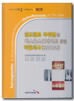 임프란트 주위염과 비스포스포네이트 관련 악골괴사(아! 이(齒)를 어쩌나) 제2편