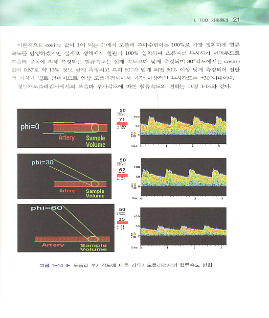 경두개도플러 검사(Transcranial Doppler)