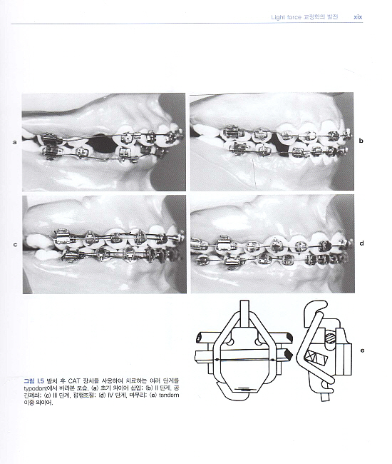 자가결찰 장치를 이용한 교정치료