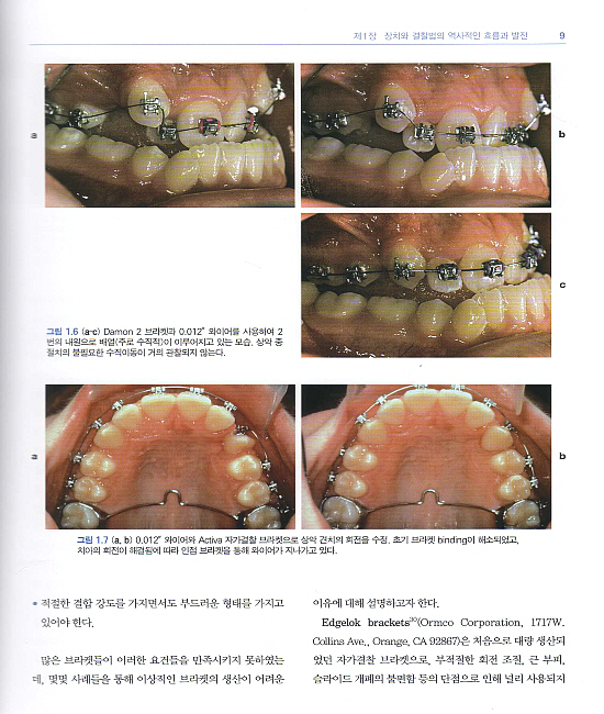 자가결찰 장치를 이용한 교정치료