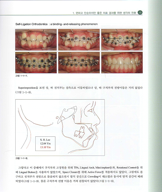 Efficiency and Excellence in Self-Ligation Orthodontics