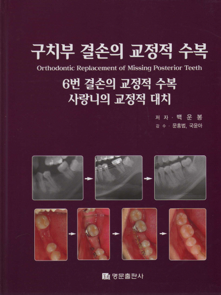 구치부 결손의 교정적 수복 -Orthodontic Replacement of Missing Posterior Teeth-