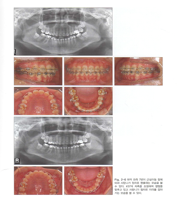 구치부 결손의 교정적 수복 -Orthodontic Replacement of Missing Posterior Teeth-