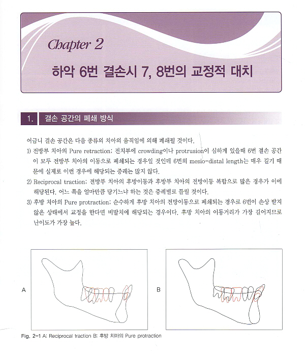 구치부 결손의 교정적 수복 -Orthodontic Replacement of Missing Posterior Teeth-