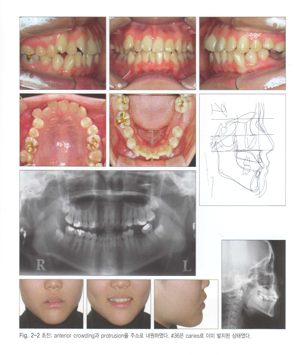 구치부 결손의 교정적 수복 -Orthodontic Replacement of Missing Posterior Teeth-