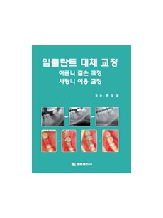 임플란트 대체 교정 (어금니 결손 교정 / 사랑니 이용 교정)