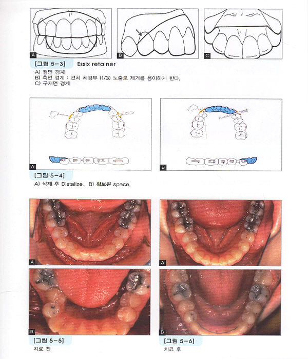 성장중인 혼합치열기 아동의 정형적 · 교정적 치료