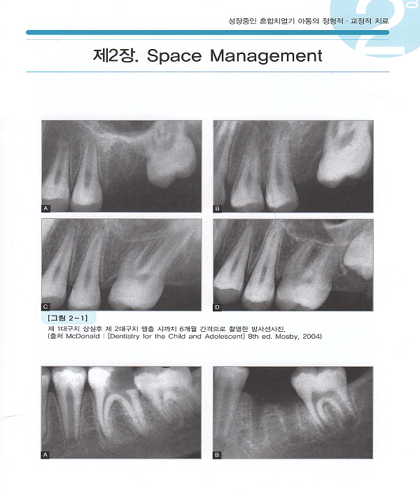 성장중인 혼합치열기 아동의 정형적 · 교정적 치료