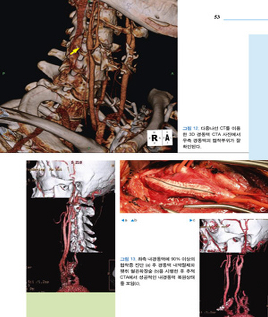 경동맥질환:진단과치료(DVD포함)