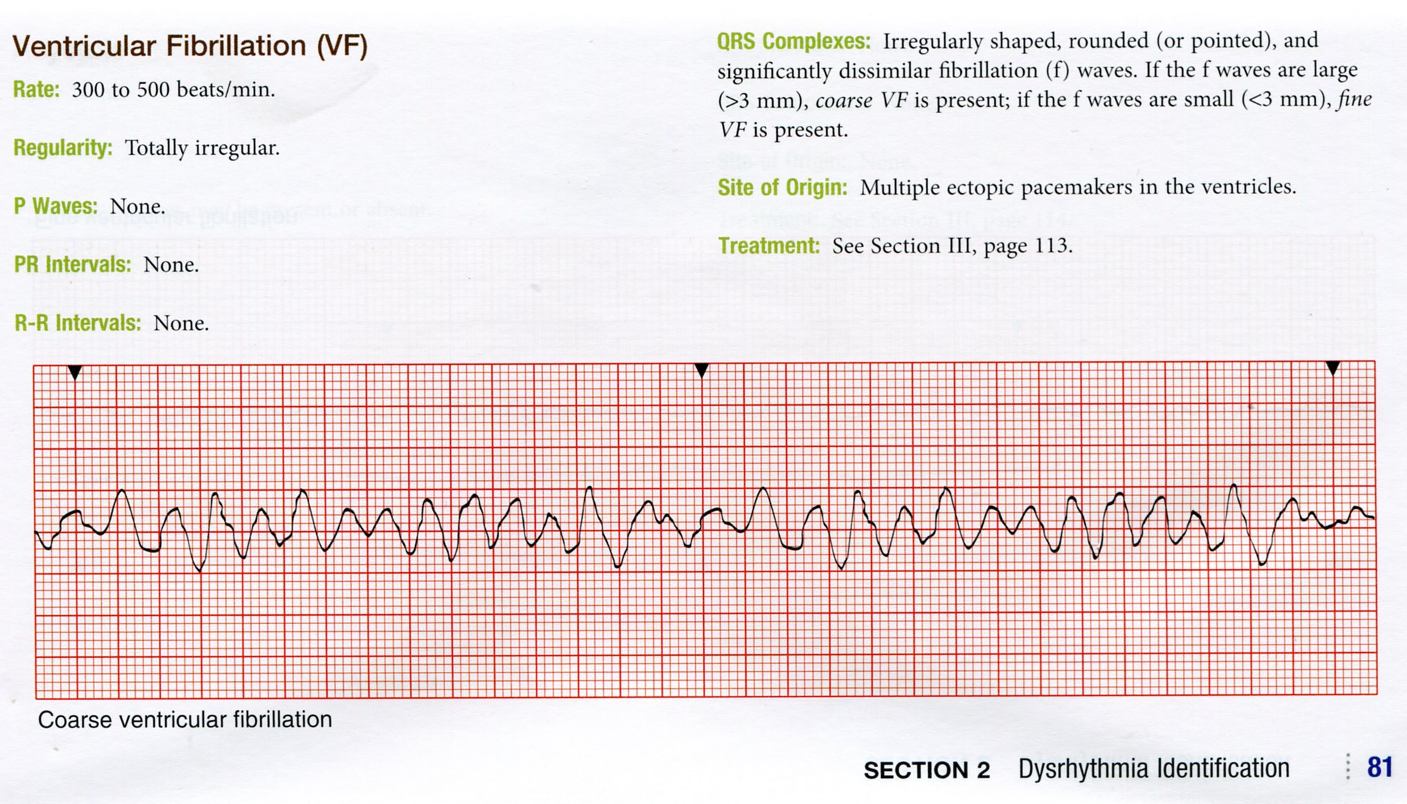 Basic Dysrhythmias and Coronary Syndromes - Pocket Guide for Huszar's