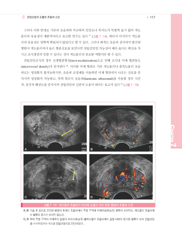 전립선질환의 영상 (전립선초음파와 영상)