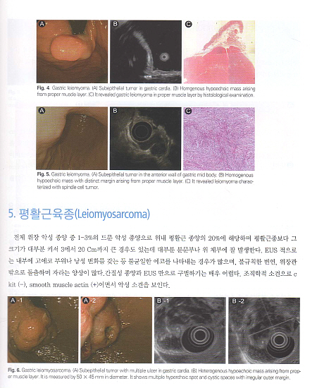 내시경초음파