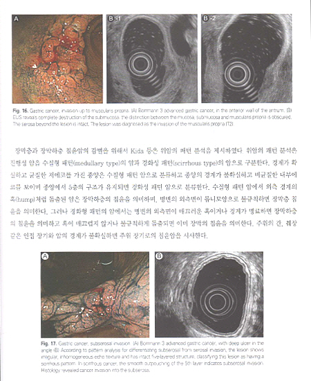 내시경초음파