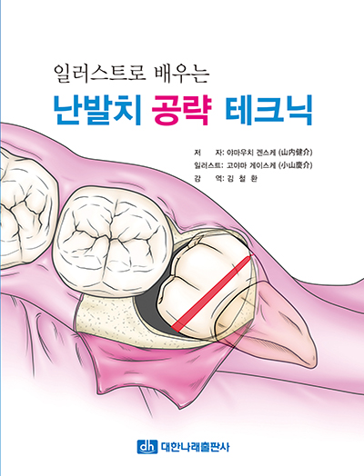 일러스트로 배우는 난발치 공략 테크닉