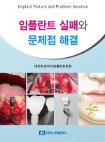 임플란트 실패와 문제점 해결