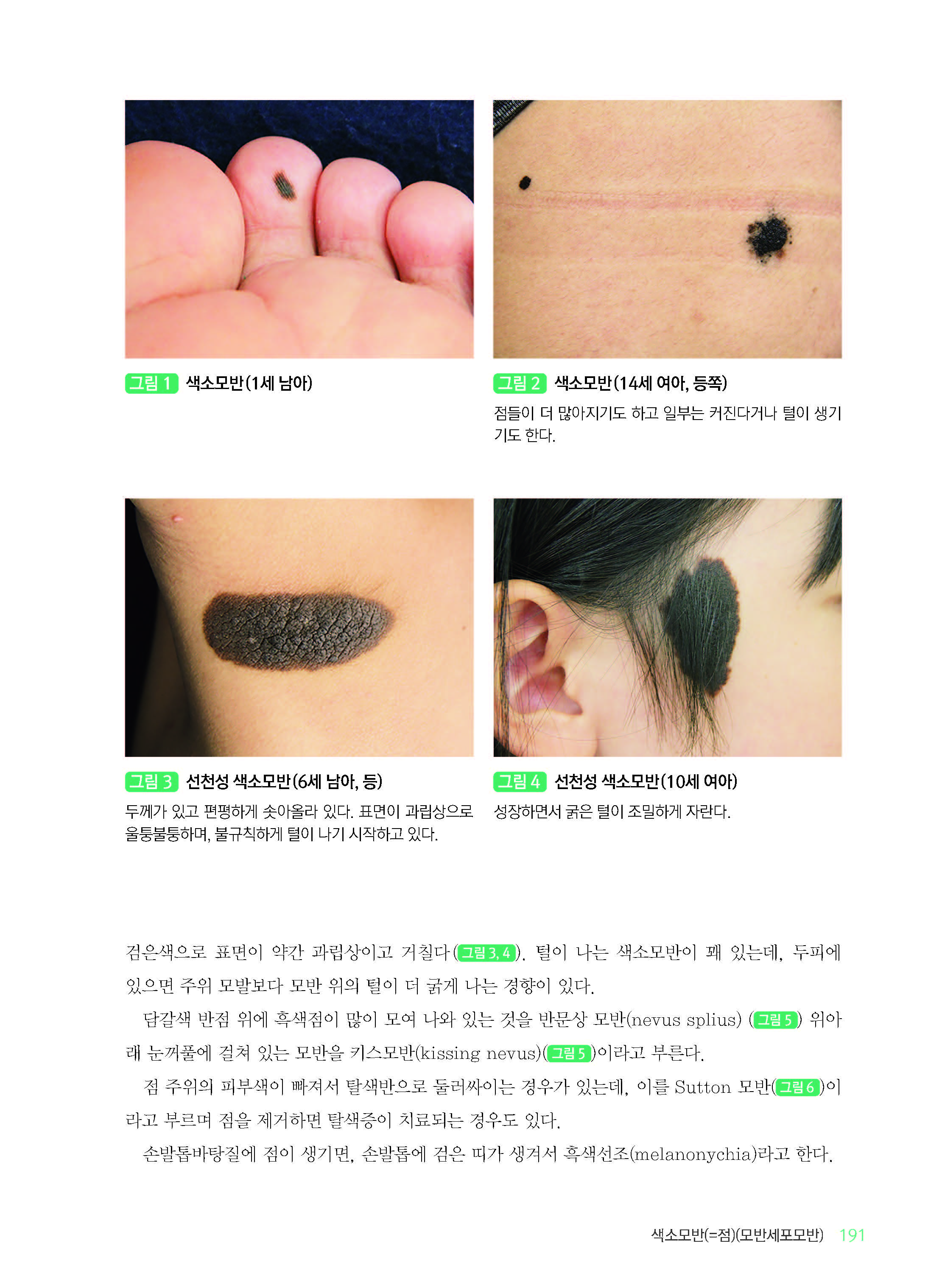 진료실에서 흔히 접하는 소아청소년 피부질환