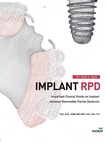 Dr. Huh`s Q&A IMPLANT RPD